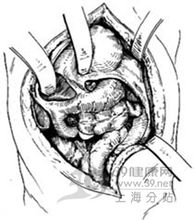 示意图8:胃、脾、小肠及结肠曲疝入胸腔