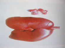 图3 肾与淋巴结病变