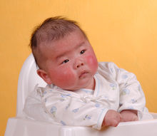 婴儿皮肤黏膜淋巴结综合症