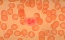 肥大细胞白血病 肥大细胞白血病